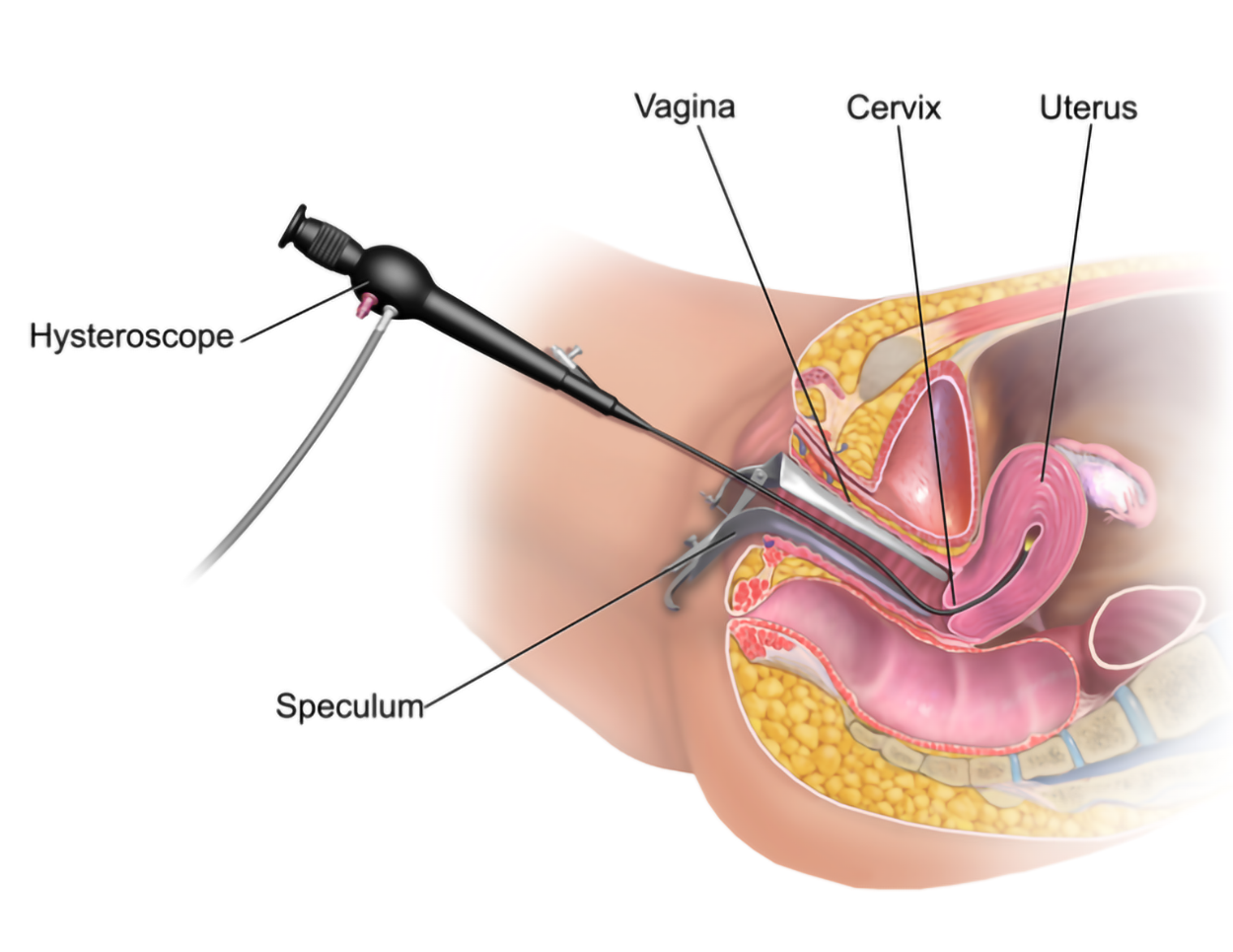 A long, thin hysteroscope is inserted through a speculum inserted in a woman’s vagina. The hysteroscope extends through the vagina and cervix into the uterus.