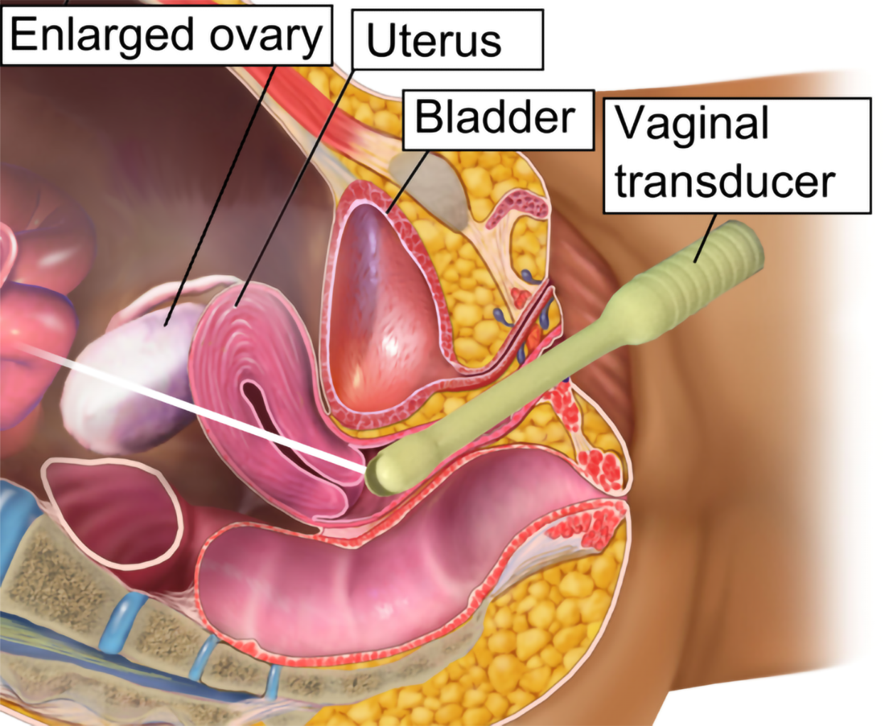 A cylindrical vaginal transducer is inserted through the vagina. The uterus separates the vaginal transducer from an enlarged ovary. The bladder is nestled between the uterus and the vagina.