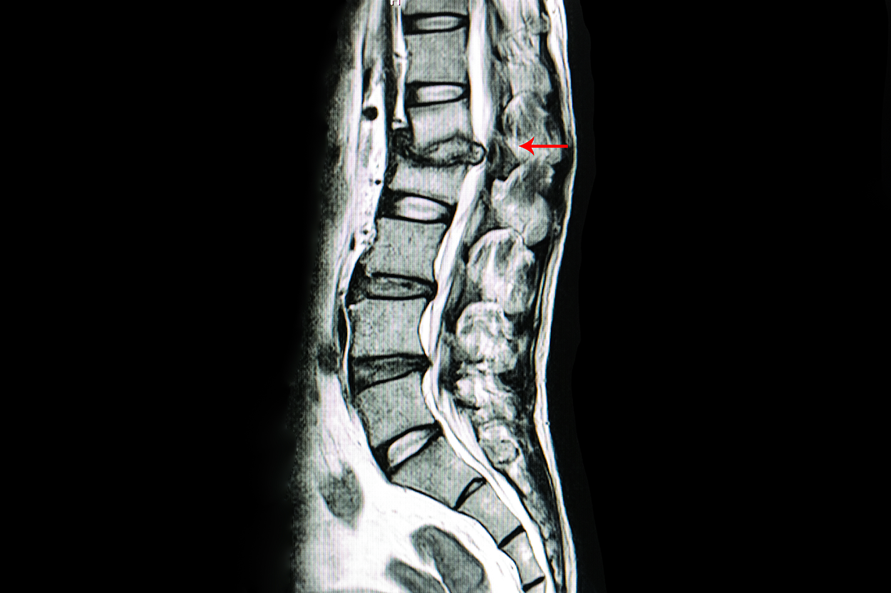 An MRI image of the lower back shows vertebrae. There are repeating patterns of dark with brighter discs, but the place where a bottom disc would be located is darker with the darker region protruding to the right.
