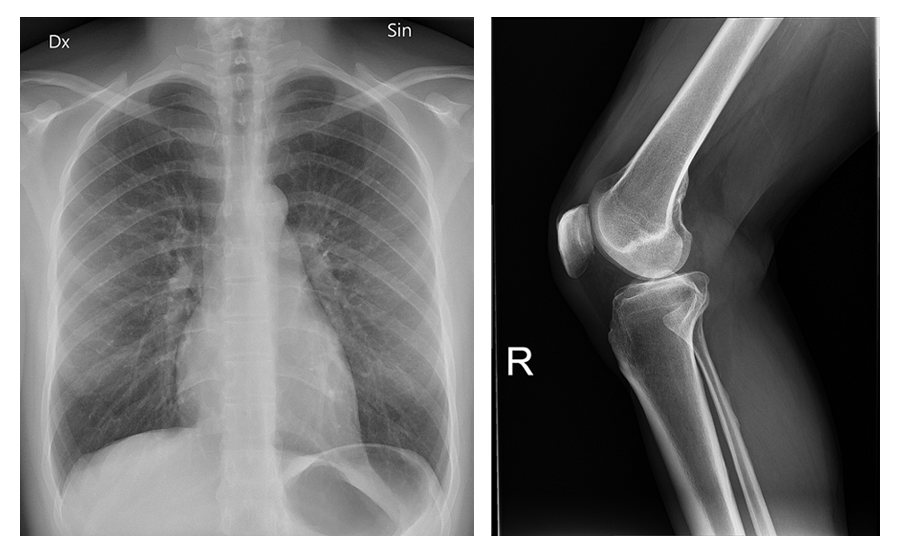 An X-ray shows a chest, including ribs; the ribs vertebrae, and other bones are whiter than the dark lung regions. A second X-ray shows bones above and below a knee. The bone outlines are bright white and surrounding tissues are more gray.