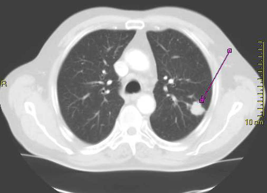 A chest CT shows the lungs.