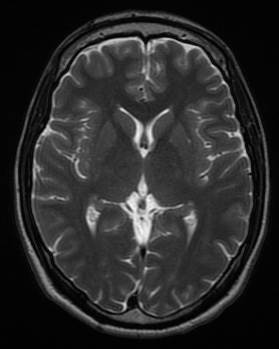 A T2-weighted MRI of the brain.