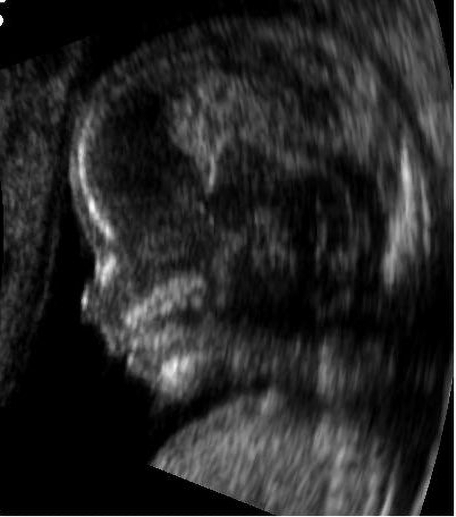 An ultrasound shows 14-week-old fetus.