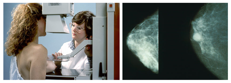 Left: A woman undergoes a mammogram. Her right breast is positioned on a rectangular shelf below a plate that her provider lowers onto it. Right: Mammograms show a healthy breast on the left and a breast with a bright, white, spherical area of breast cancer on the right.