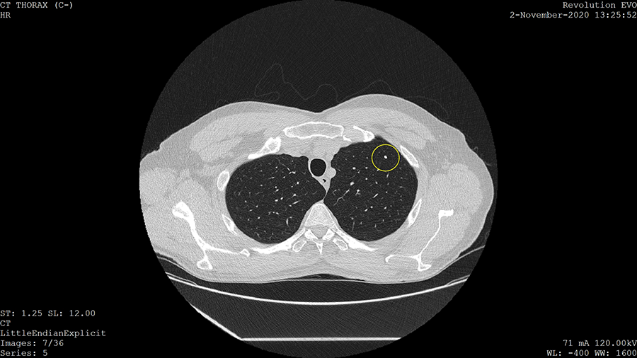 This LDCT image shows a small, bright spot indicated with a circle. This spot is a calcified nodule.