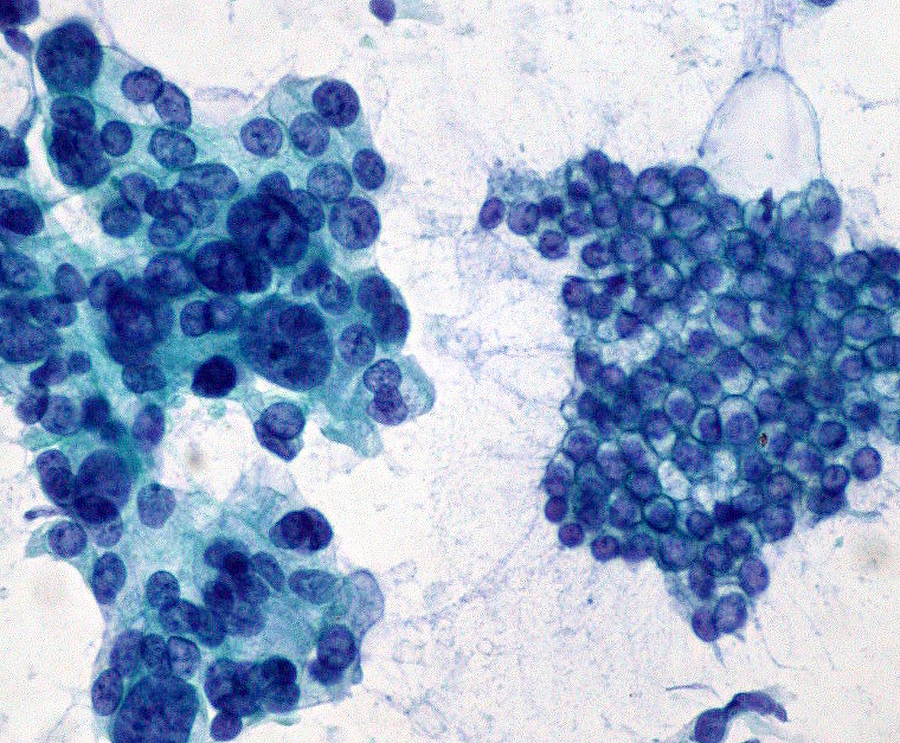 Sample obtained using fine needle aspiration.