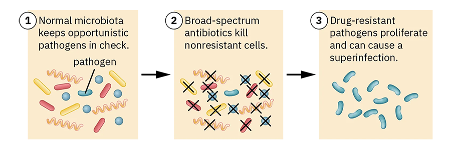 1. Normal microbiota keeps opportunistic pathogens in check; a variety of microbes are present. 2. Broad-spectrum antibiotics kill nonresistant cells; only a pathogen survives. 3. Drug-resistant pathogens proliferate and can cause a superinfection. Many pathogens are present with no other cells visible.