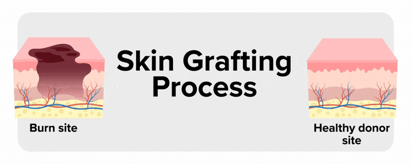 A header reads ‘Skin Grafting Process’. On the left is a cross-section labeled ‘Burn Site’, showing a burn affecting the top two layers of skin. On the right is a healthy skin cross-section labeled ‘Healthy Donor Site’. Both images and the header fade upward. A human hand and arm appear, with a dotted rectangle near the wrist. A rectangle of skin lifts from this area, labeled ‘Skin removed from healthy donor’. The left half of the screen becomes transparent, and three rectangles slide in with text: